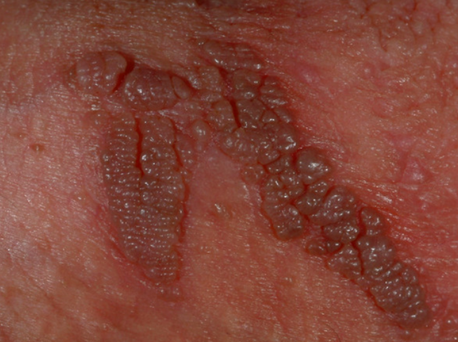  اعراض الثاليل التناسلية